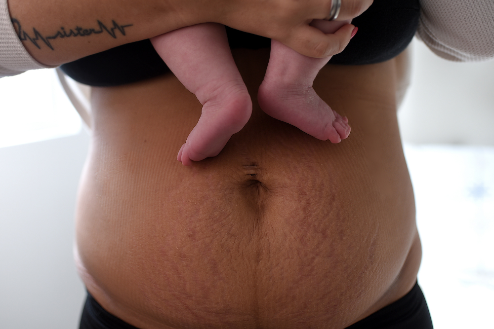 diastasis recti